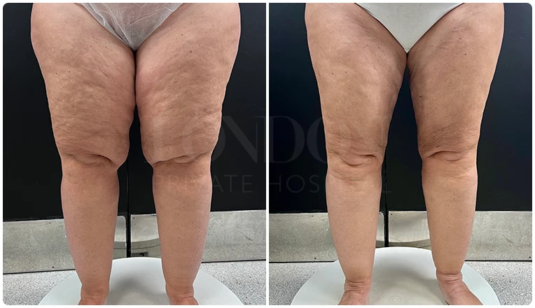 lipedema surgery before and after patient -4