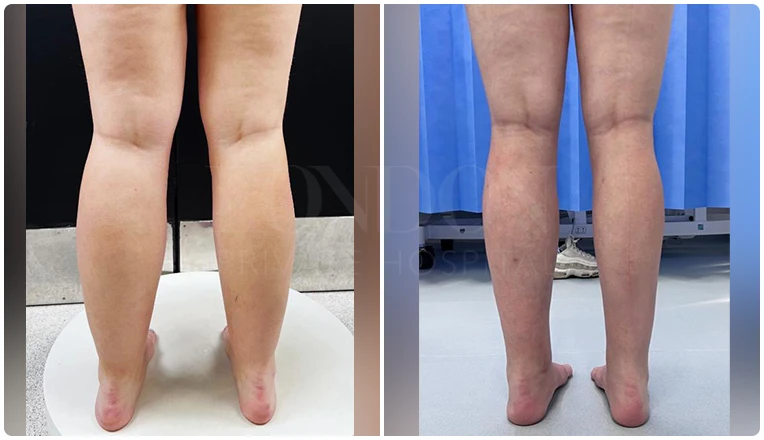 lipedema surgery before and after patient -5-v1