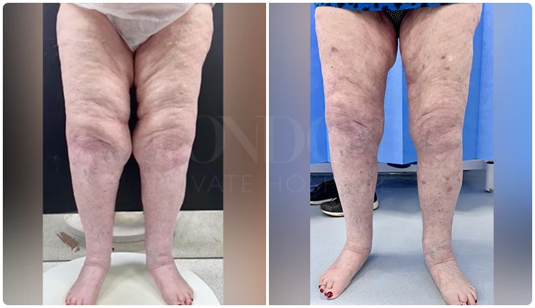 lipedema surgery before and after patient -5-v2