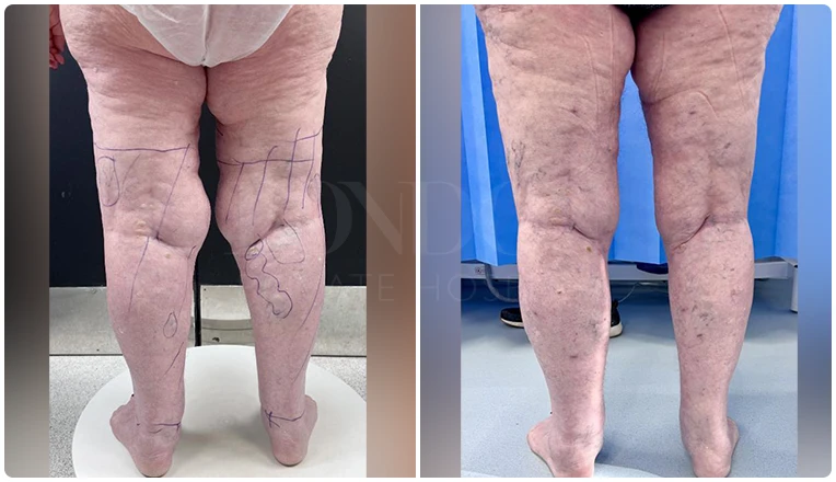 lipedema surgery before and after patient -5-v3