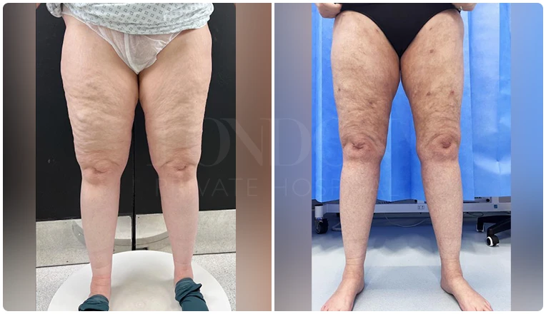 lipedema surgery before and after patient -5