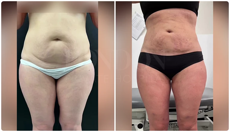 stomach vaser liposuction before and after-10