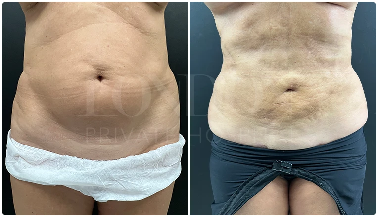 stomach vaser liposuction before and after-11
