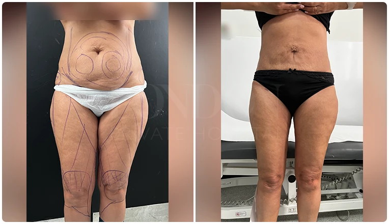 stomach vaser liposuction before and after-12