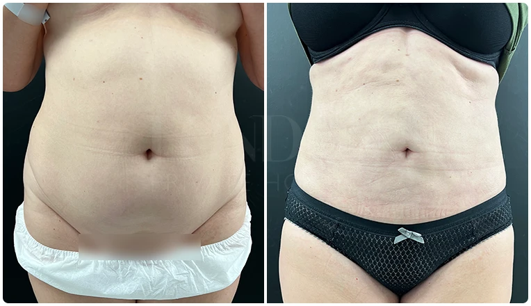 stomach vaser liposuction before and after-13