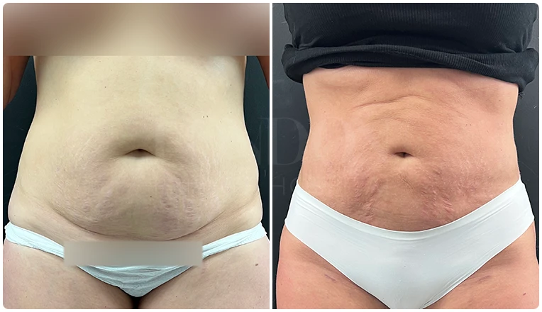 stomach vaser liposuction before and after-14