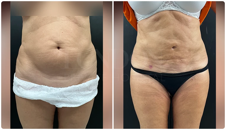 stomach vaser liposuction before and after-15