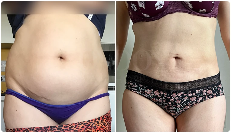 stomach vaser liposuction before and after-16