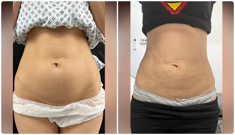 stomach vaser liposuction before and after-17