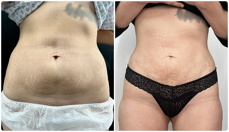 stomach vaser liposuction before and after-18