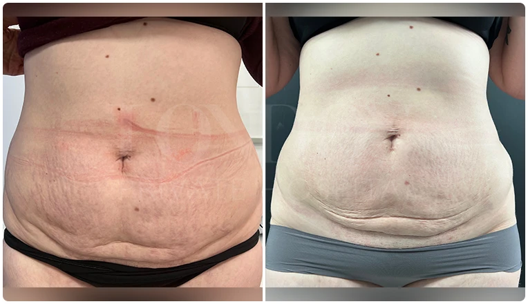 stomach vaser liposuction before and after-2