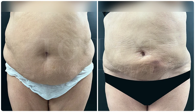stomach vaser liposuction before and after-3