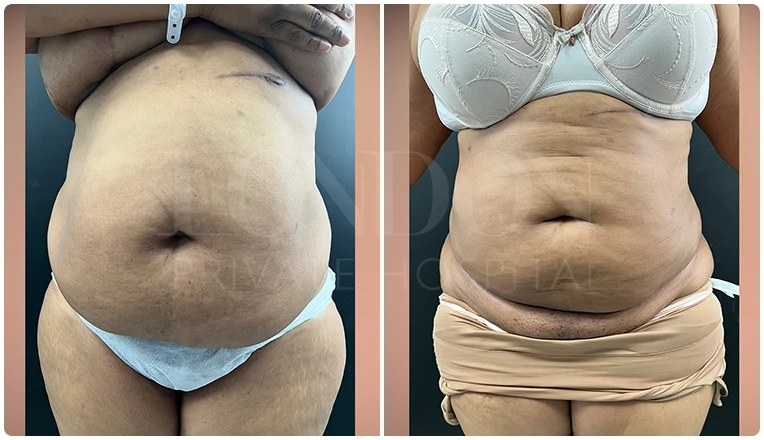 stomach vaser liposuction before and after-5