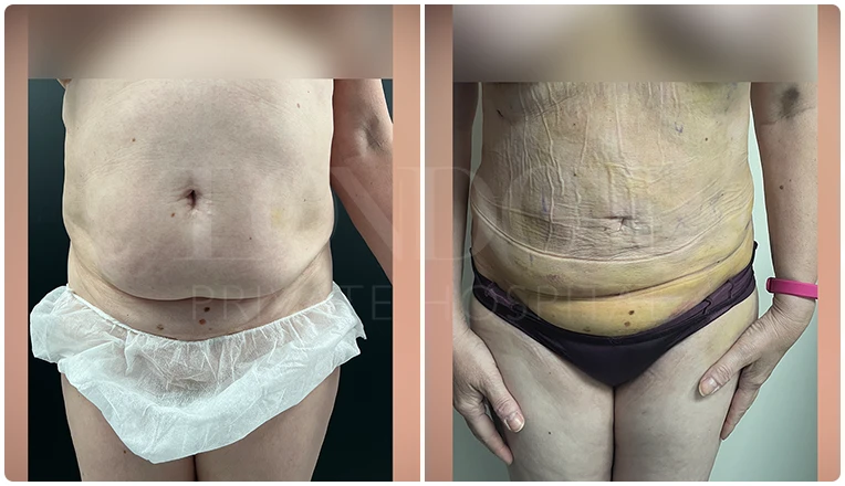 stomach vaser liposuction before and after-6