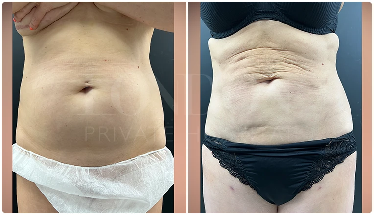stomach vaser liposuction before and after-7