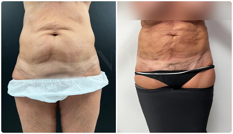 stomach vaser liposuction before and after-8