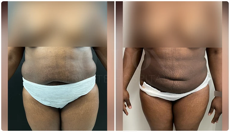 stomach vaser liposuction before and after-9