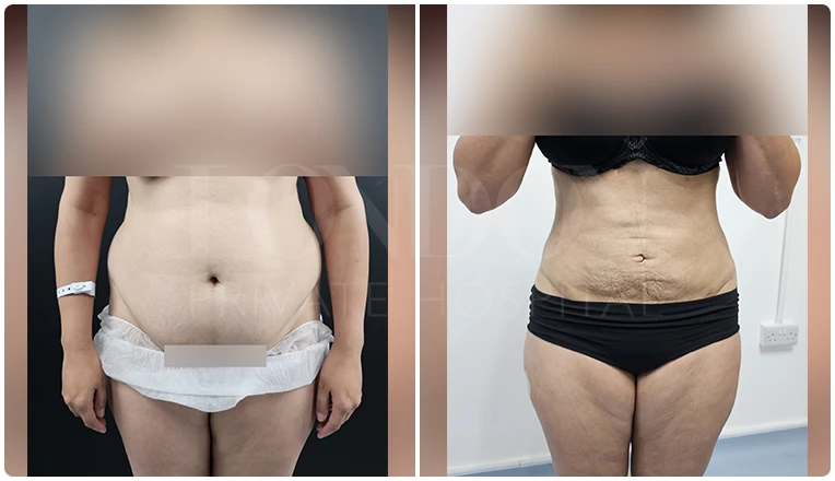 vaser lipo before and after stomach patient-1