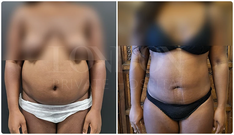 vaser lipo before and after stomach patient-2