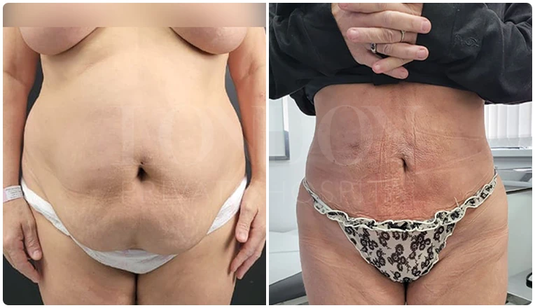 vaser lipo before and after stomach patient-3