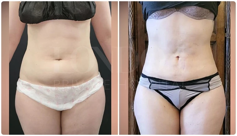 vaser lipo before and after stomach patient-4