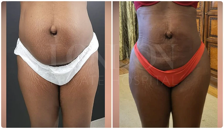 vaser lipo before and after stomach patient-5
