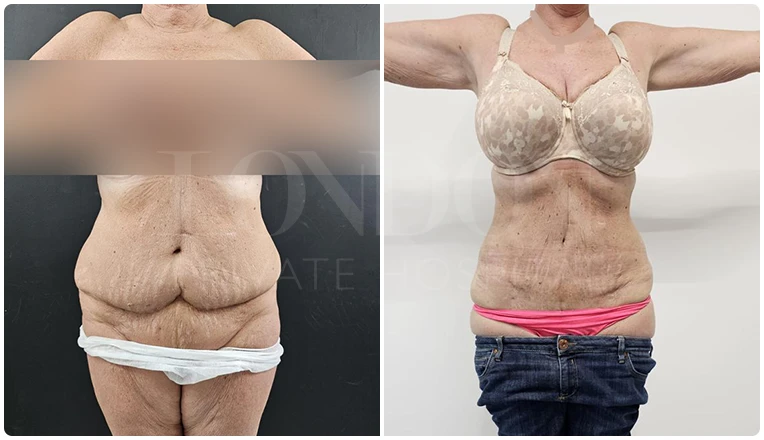 vaser lipo before and after stomach patient