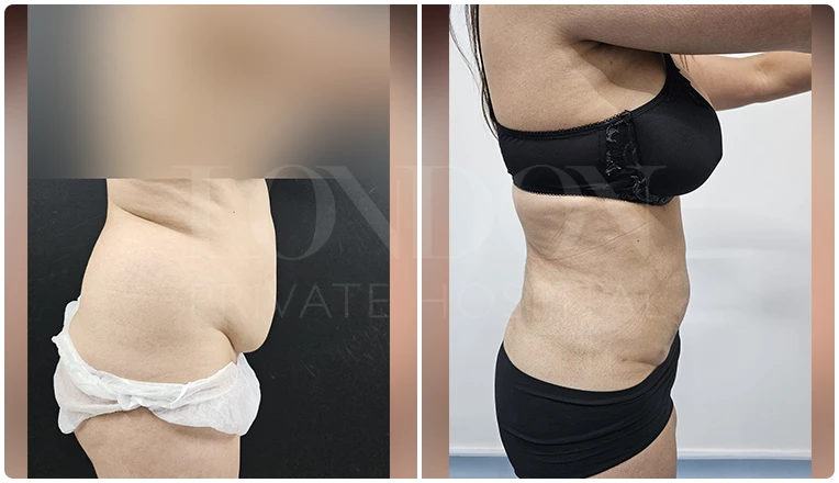 vaser lipo female abs before and after patient-1-v1