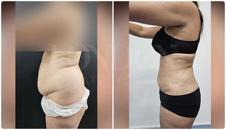 vaser lipo female abs before and after patient-1