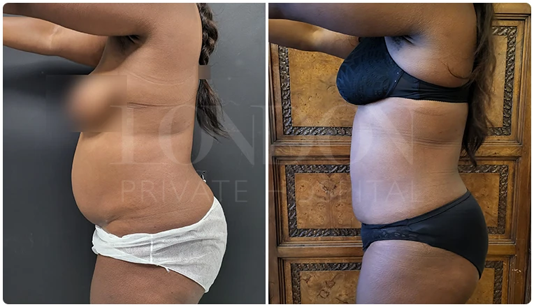 vaser lipo female abs before and after patient-2