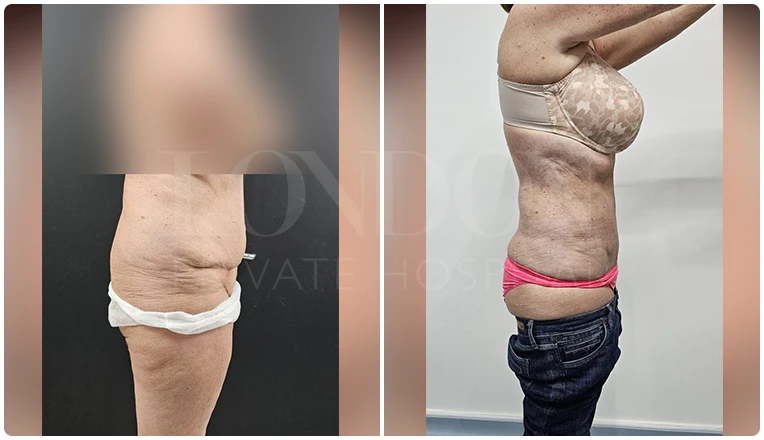 vaser lipo female abs before and after patient-v1