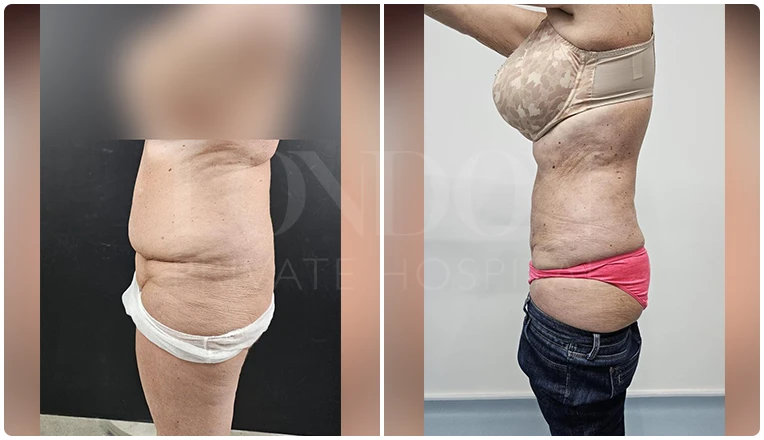 vaser lipo female abs before and after patient