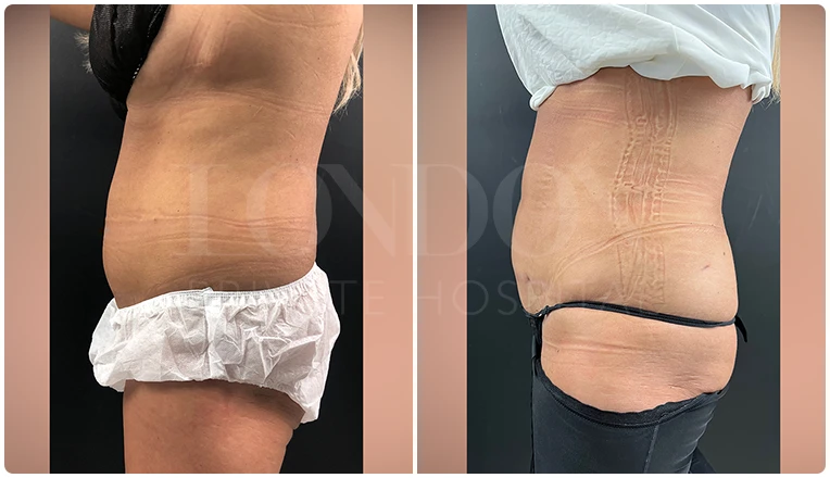 vaser lipo female abs before and after result patient-1