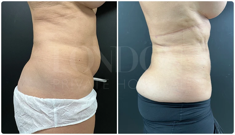 vaser lipo female abs before and after result patient-10