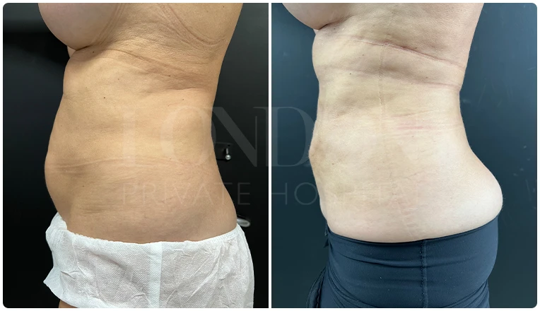 vaser lipo female abs before and after result patient-11