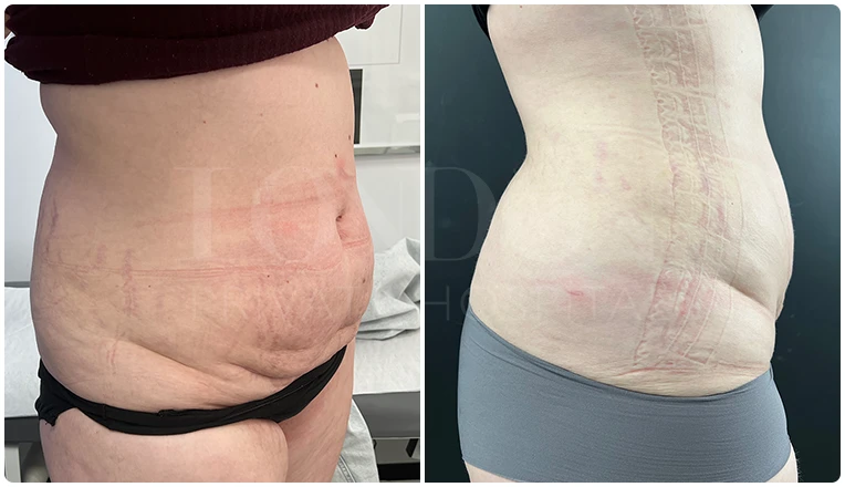 vaser lipo female abs before and after result patient-2