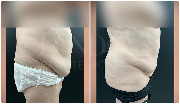 vaser lipo female abs before and after result patient-3