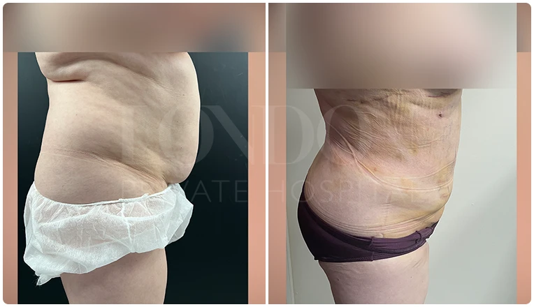 vaser lipo female abs before and after result patient-4