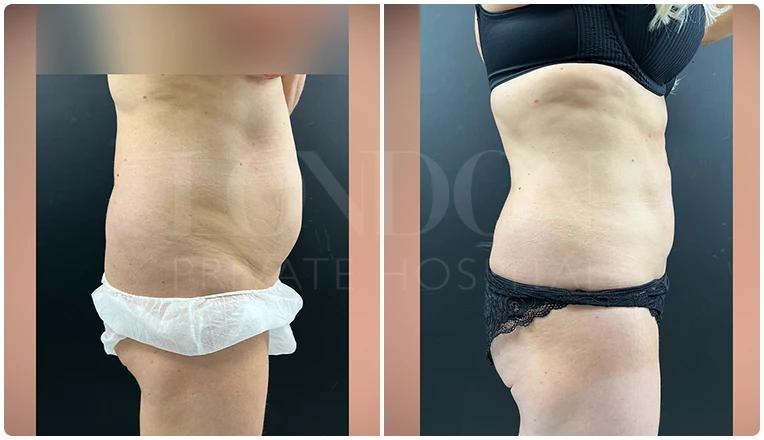 vaser lipo female abs before and after result patient-5