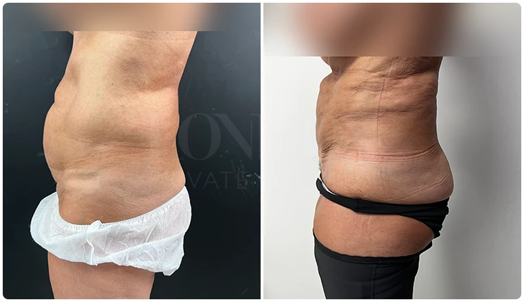 vaser lipo female abs before and after result patient-6