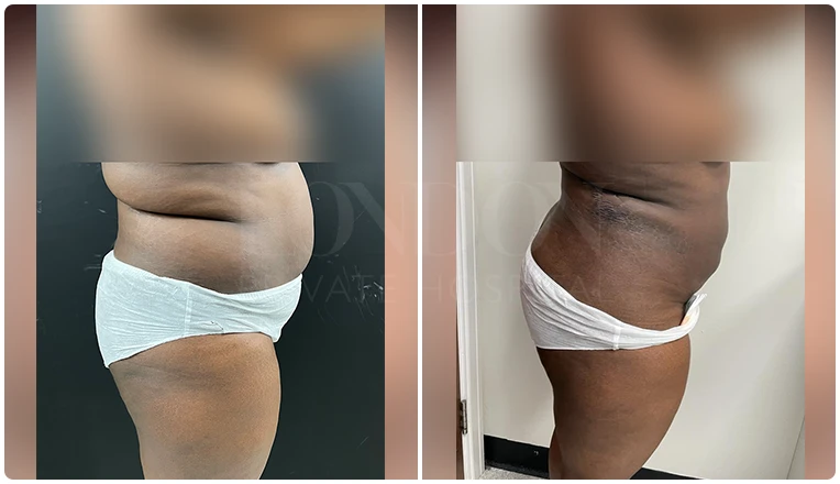 vaser lipo female abs before and after result patient-7