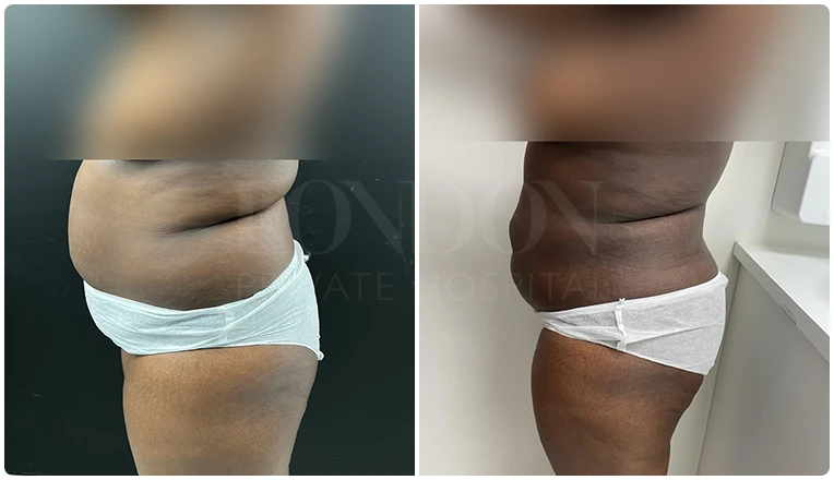 vaser lipo female abs before and after result patient-8