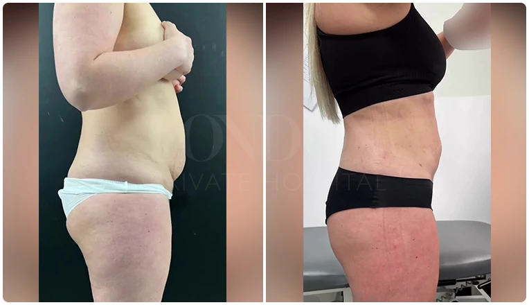 vaser lipo female abs before and after result patient-9