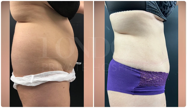 vaser lipo female abs before and after result patient