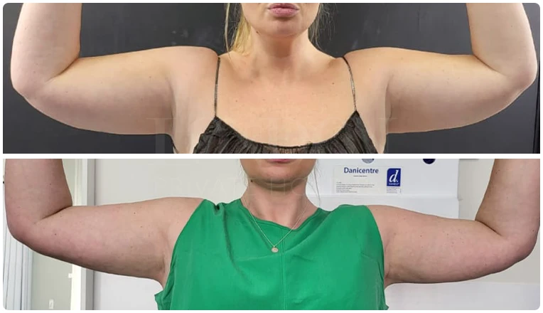 vaser lipo on arms before and after patient-2