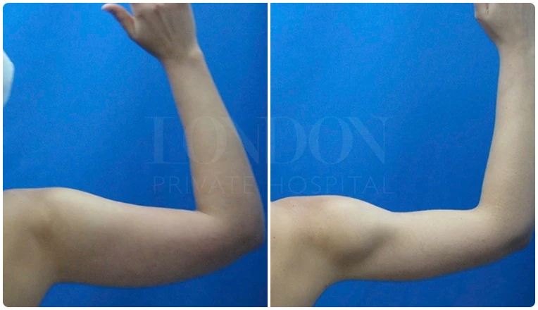 vaser lipo on arms before and after patient-4-v1