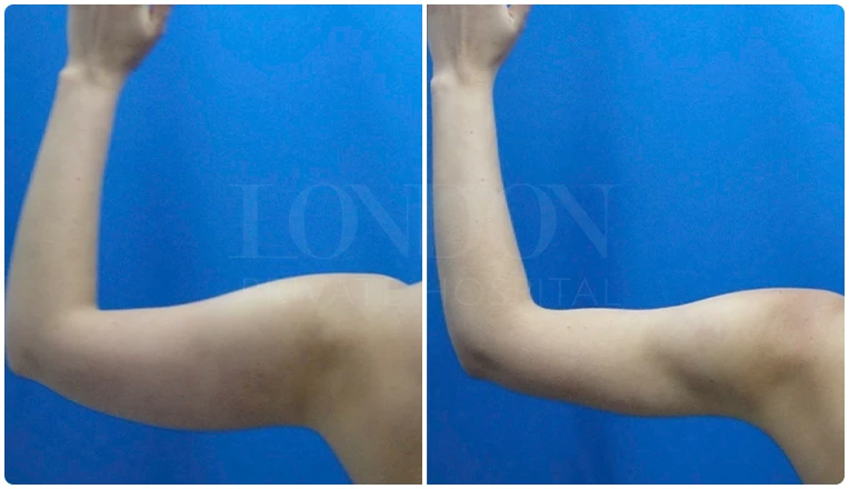 vaser lipo on arms before and after patient-4