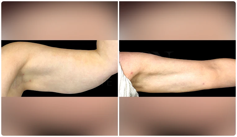 vaser lipo on arms before and after patient-5