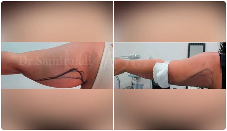vaser lipo on arms before and after patient-6