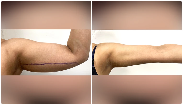 vaser lipo on arms before and after patient-7
